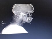 ۴۳ ساچمه در مغز؛ تاوان حفاظت از مسجد