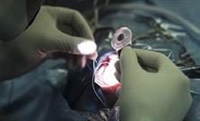 اولین عمل جراحی کاشت حلزون شنوایی در گیلان انجام شد