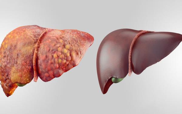 همایش بازآموزی طب ایرانی ویژه پزشکان، با محوریت کبد چرب برگزار می‌شود