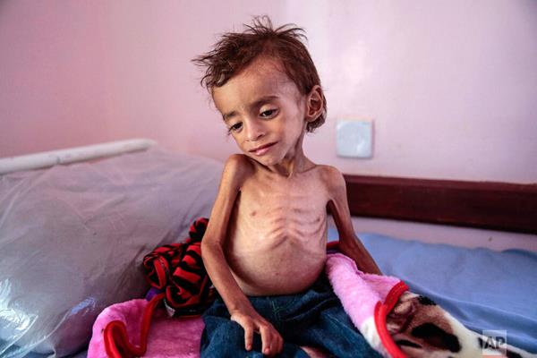 سوء تغذیه و سرطان، سهم کودکان یمنی